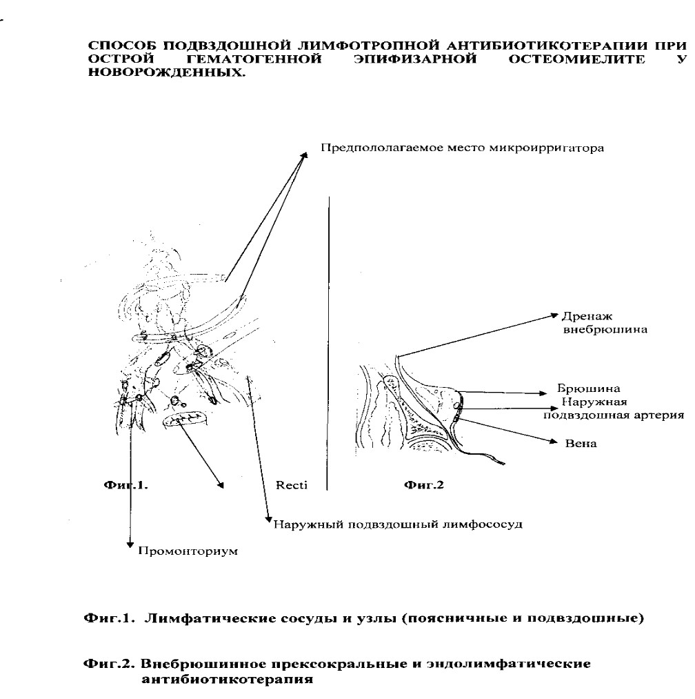 СПОСОБ ПОДВЗДОШНОЙ ЛИМФОТРОПНОЙ АНТИБИОТИКОТЕРАПИИ ПРИ ОСТРОМ ГЕМАТОГЕННОМ ЭПИФИЗАРНОМ ОСТЕОМИЕЛИТЕ У НОВОРОЖДЕННЫХ